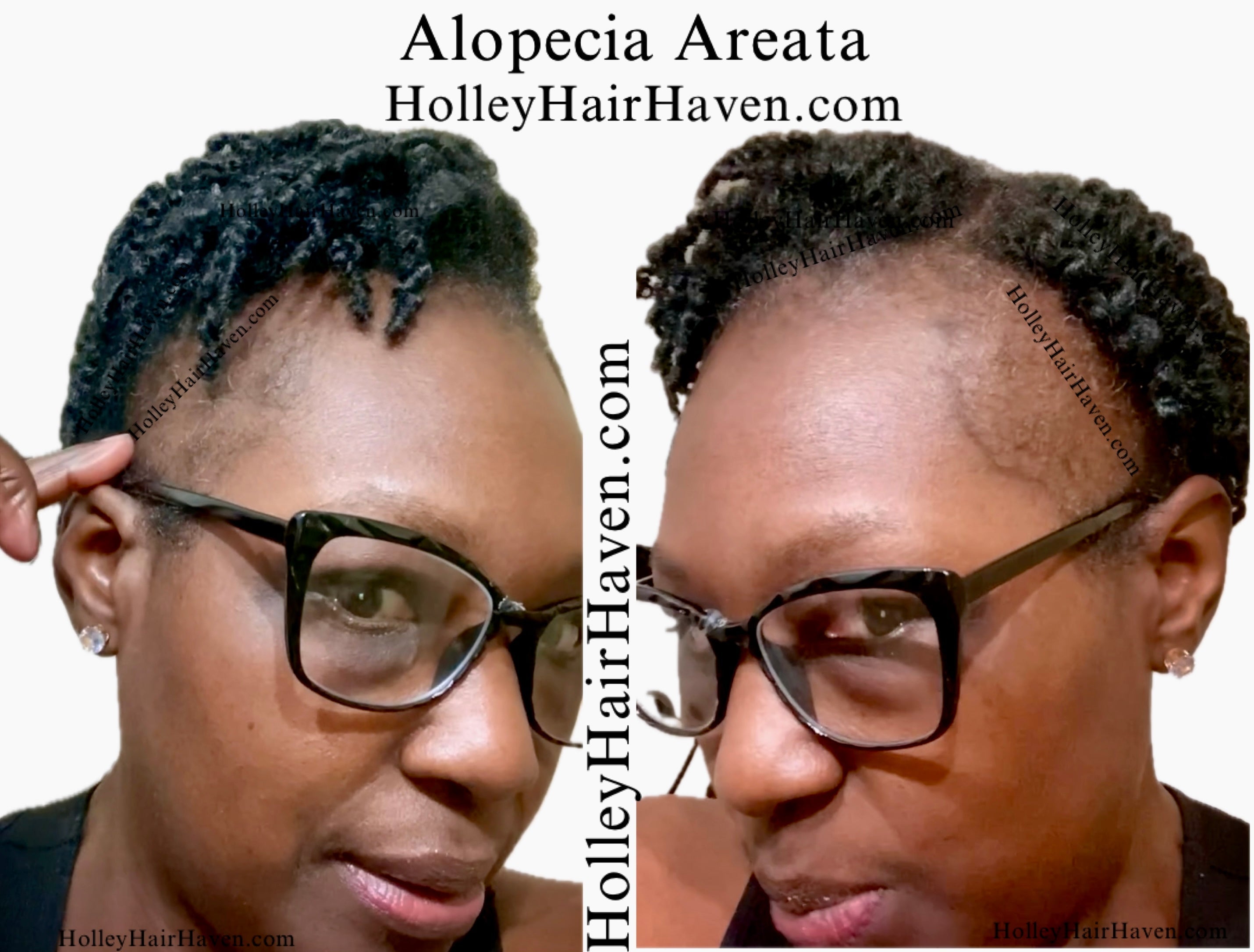 What Is Hair Loss?